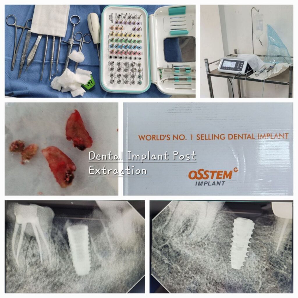 Dental implant / Extraction