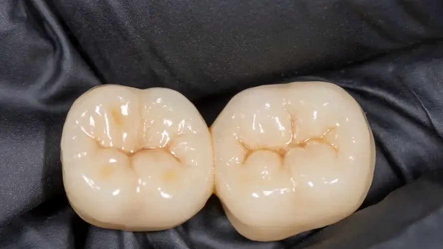 crown for molar teeth