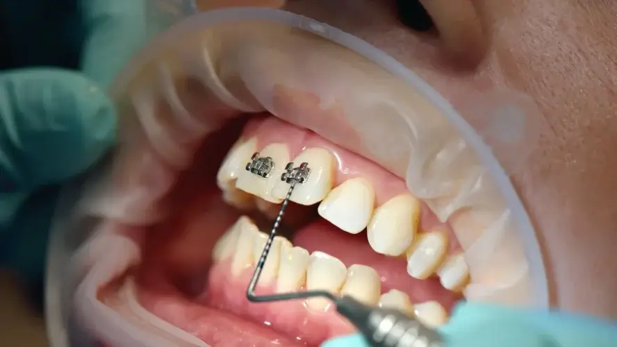 braces treatment