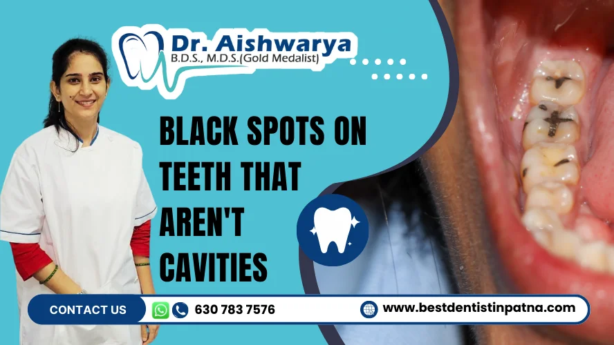 Black Spots on Teeth that Aren't Cavities