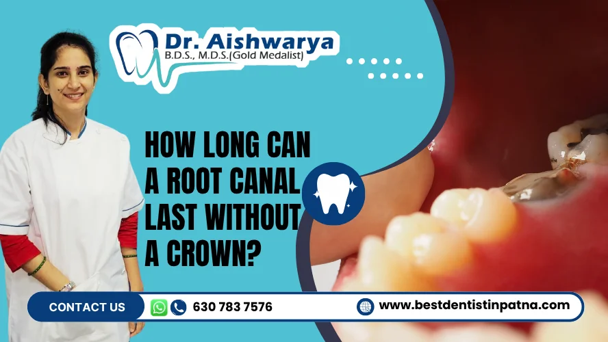 Root Canal Last Without a Crown