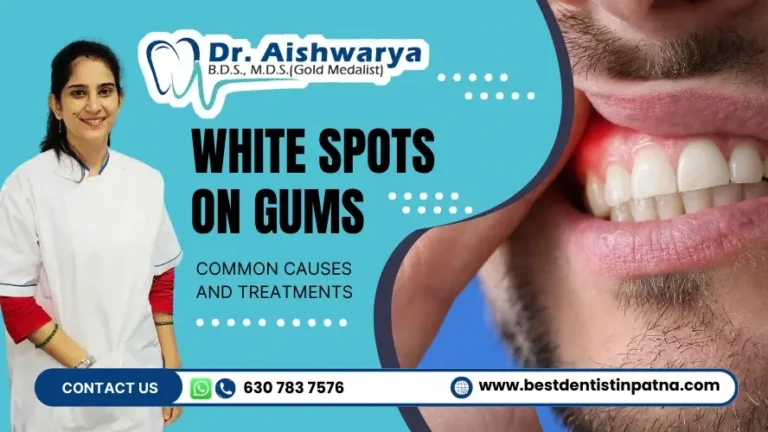 Treatment Options for White Spots on Gums – 6 Common Causes