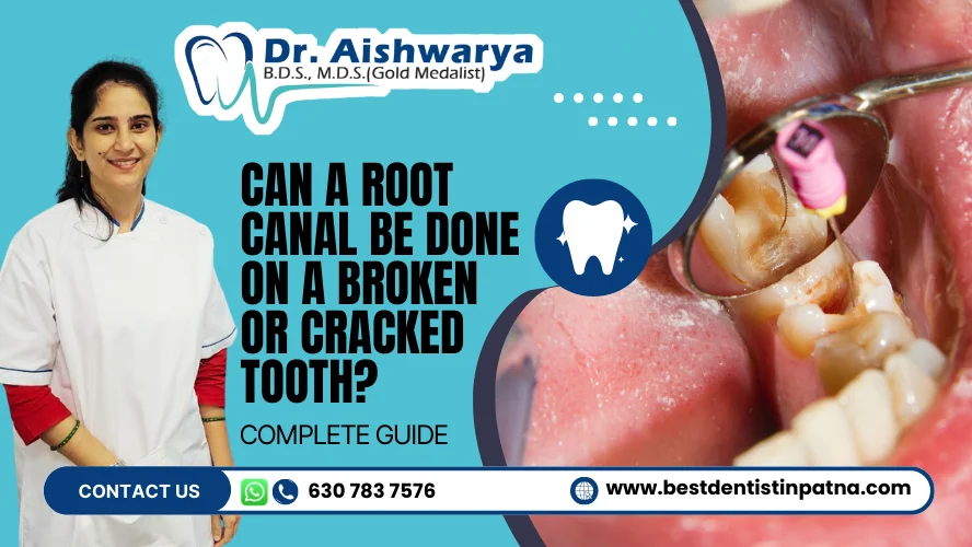 Can a Root Canal Be Done on a Broken or Cracked Tooth