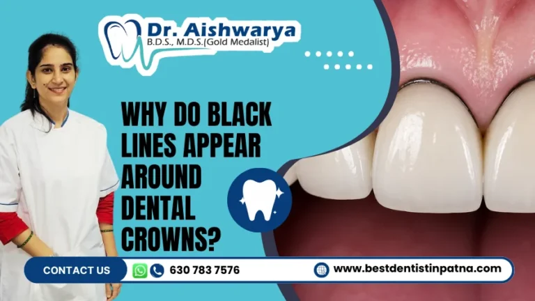 Black Lines Around Dental Crowns: Causes & Treatment