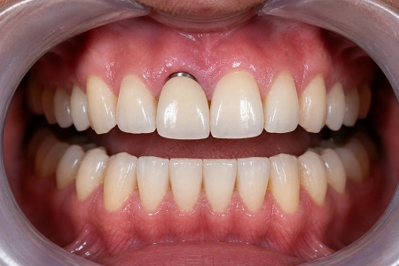 after implant