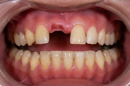dental implant before