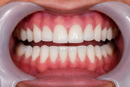 teeth cleaning after