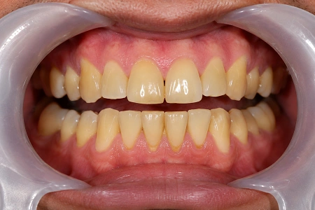teeth cleaning before