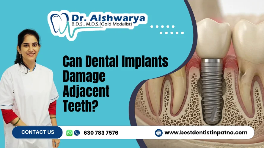 Can Dental Implants Damage Adjacent Teeth
