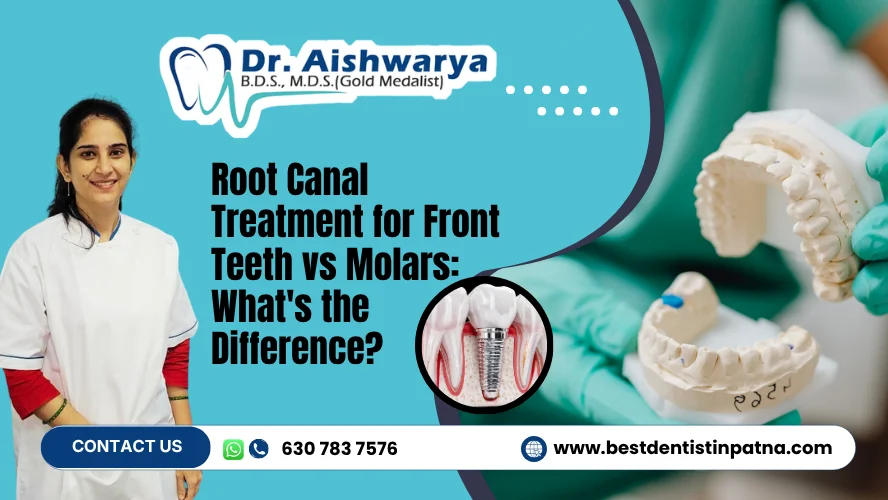 Root Canal Treatment for Front Teeth vs Molars